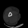 SPORK, NICO - 22.03.1976 - 02.08.2022 - CT obere Extremität - 17:51:17